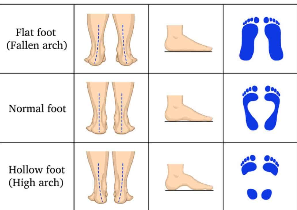 Supinated, Pronated, and Flat Foot Types